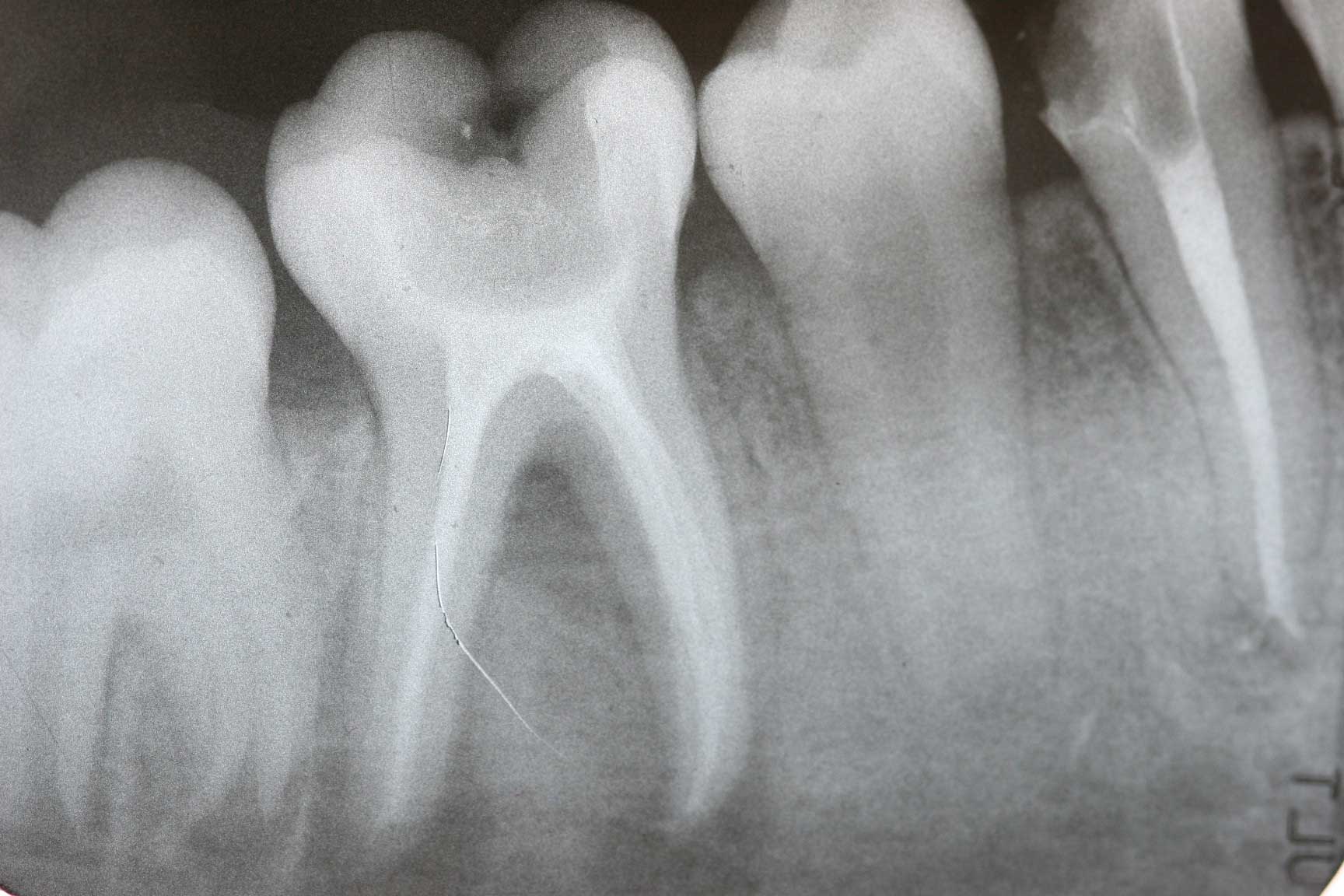 Фото Рентгена Здоровых Зубов